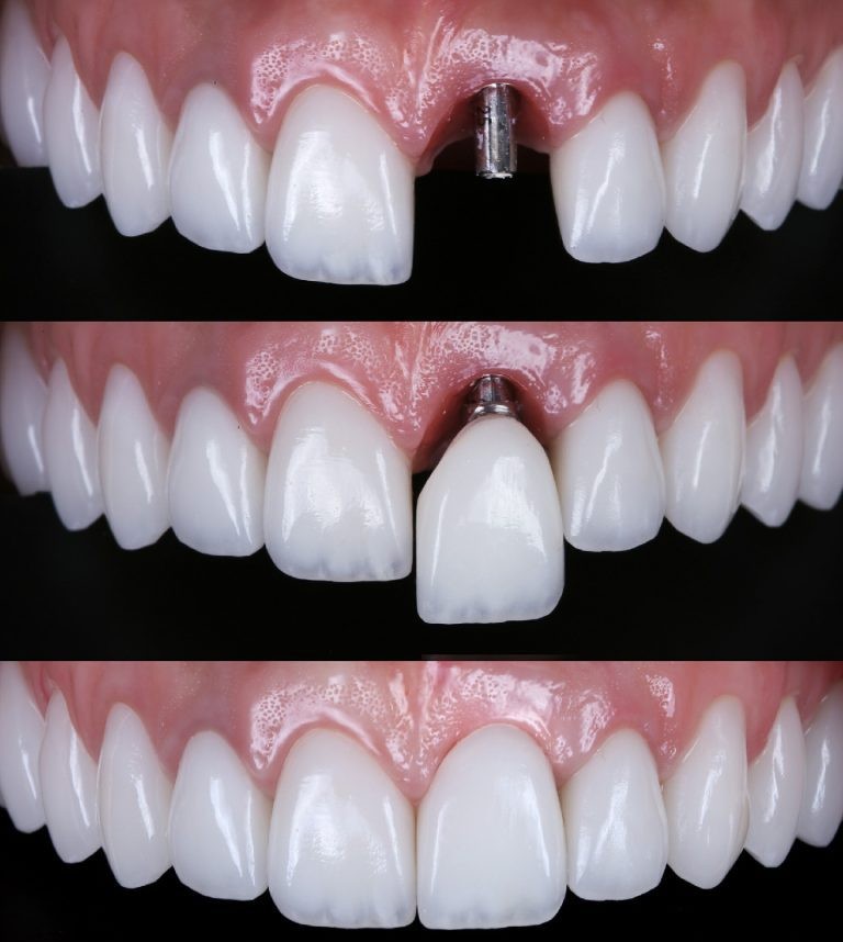 Antes e depois - Implantodontia